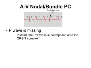 A-V Nodal/Bundle PC P wave is missing Instead, the P wave is superimposed onto the QRS-T complex* 