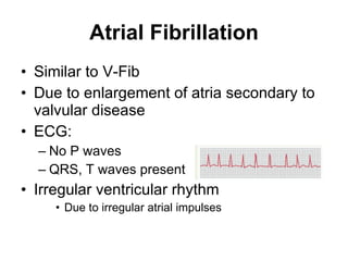 Atrial Fibrillation Similar to V-Fib Due to enlargement of atria secondary to valvular disease ECG:  No P waves  QRS, T waves present Irregular ventricular rhythm Due to irregular atrial impulses 