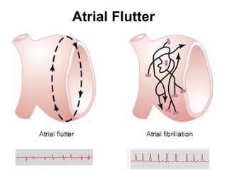 Atrial Flutter 