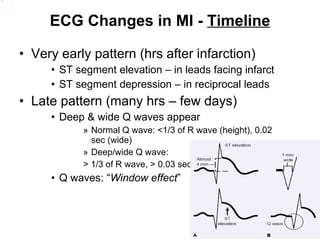 ECG Changes in MI -  Timeline Very early pattern (hrs after infarction) ST segment elevation – in leads facing infarct ST segment depression – in reciprocal leads Late pattern (many hrs – few days) Deep & wide Q waves appear Normal Q wave: <1/3 of R wave (height), 0.02 sec (wide)  Deep/wide Q wave:  > 1/3 of R wave, > 0.03 sec Q waves: “ Window effect ” 