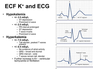 ECF K +  and ECG Hypokalemia +/- 3.5 mEq/L ST depression Prominent U wave +/- 2.5 mEq/L PR interval prolonged ST depression T wave inverts Prominent U wave Hyperkalemia +/- 7.0 mEq/L Tall slender, peaked T waves present +/- 8.5 mEq/L No evidence of atrial activity QRS – broad and slurred QRS interval – wide T waves remain tall, slender Further increase in K+ - ventricular tachycardia or fibrillation 
