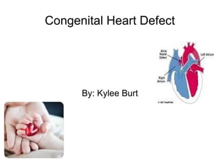 Congenital Heart Defect 
By: Kylee Burt 
 