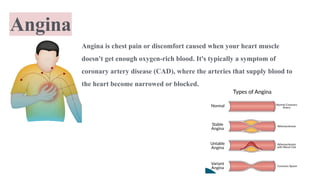 ISCHEMIC HEART DISEASE (Cardiovascular System)) | PDF