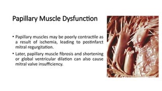 Papillary Dysfunction Comprehensive Overview of Heart Anatomy and Myocardial Infarction ...