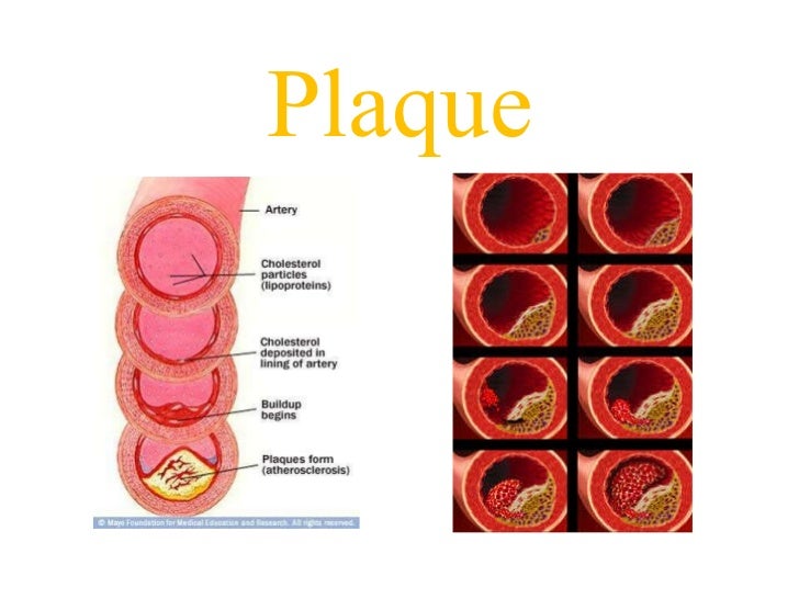 Heart attack plaque blood pressure