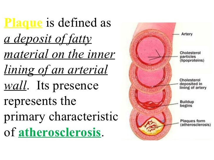 Heart attack plaque blood pressure