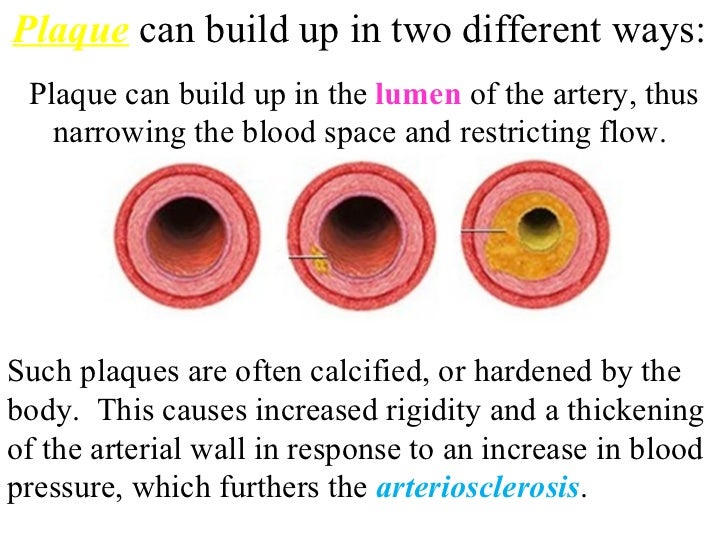 Heart attack plaque blood pressure