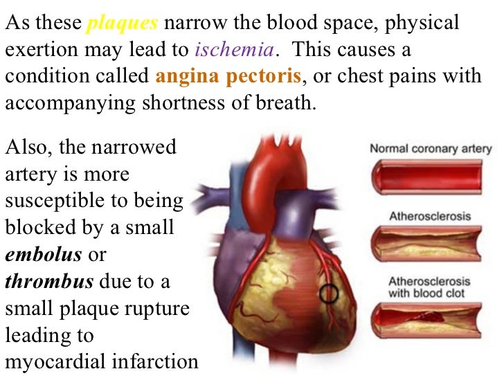 Heart attack plaque blood pressure
