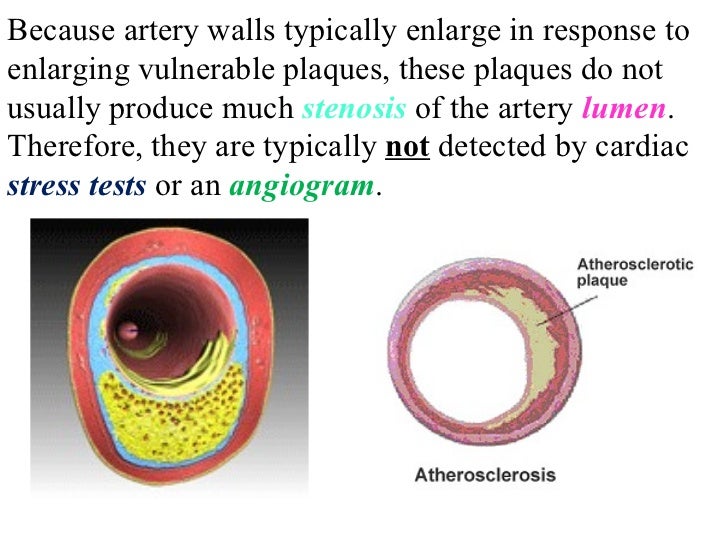 Heart attack plaque blood pressure