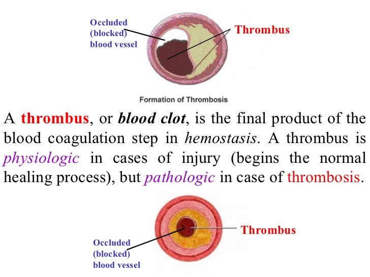 Heart attack plaque blood pressure