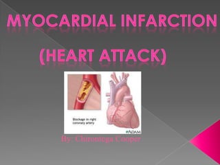 Myocardial infarction (Heart Attack) By: Chirontega Cooper 
