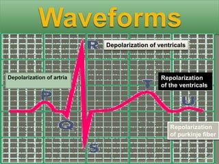 Depolarization of ventricals




Depolarization of artria                      Repolarization
                                              of the ventricals




                                                 Repolarization
                                                 of purkinje fiber
 
