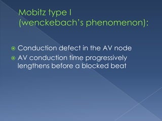 Conduction defect in the AV node
 AV conduction time progressively
lengthens before a blocked beat


 