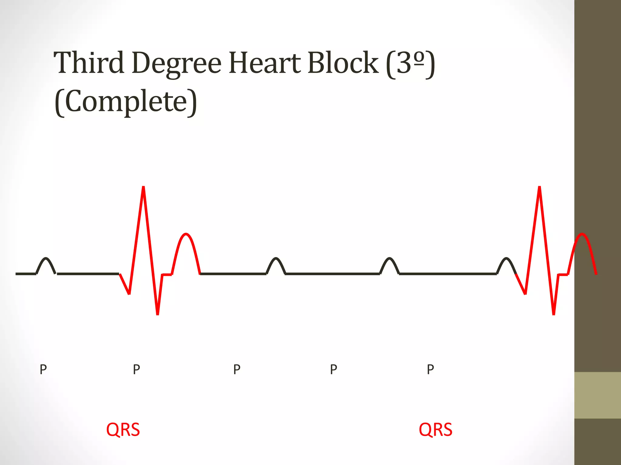 Heart block | PPTX