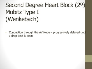 Second Degree Heart Block (2º)
Mobitz Type I
(Wenkebach)
• Conduction through the AV Node – progressively delayed until
a drop beat is seen
 