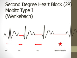 Second Degree Heart Block (2º)
Mobitz Type I
(Wenkebach)
PR PR PR DROPPED BEAT
 