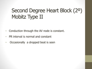 Second Degree Heart Block (2º)
Mobitz Type II
• Conduction through the AV node is constant.
• PR interval is normal and constant
• Occasionally a dropped beat is seen
 