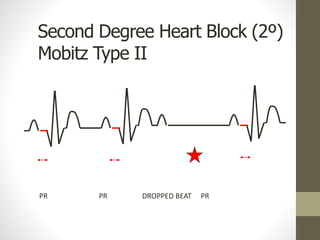 Second Degree Heart Block (2º)
Mobitz Type II
PR PR DROPPED BEAT PR
 