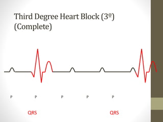 Third Degree Heart Block (3º)
(Complete)
P P P P P
QRS QRS
 