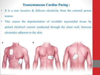 Transcutaneous Cardiac Pacing :
• It is a non invasive & delivers electricity from the external power
source.
• This causes the depolarization of excitable myocardial tissue by
pulsed electrical current conducted through the chest wall, between
electrodes adherent to the skin.
 