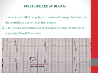 FIRST DEGREE AV BLOCK :
 It occurs when all the impulses are conducted through AV Node into
the ventricles at a rate slower than normal.
 It is a disease of electrical conduct system in which PR interval is
lengthened than 0.20 seconds.
 