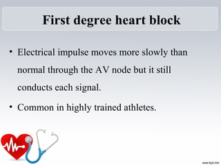 First degree heart block
• Electrical impulse moves more slowly than 
normal through the AV node but it still 
conducts each signal.
• Common in highly trained athletes.
 