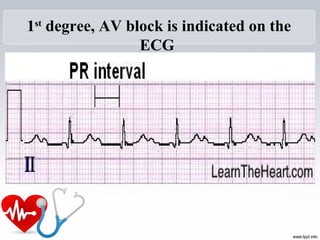 1st
degree, AV block is indicated on the
ECG
 