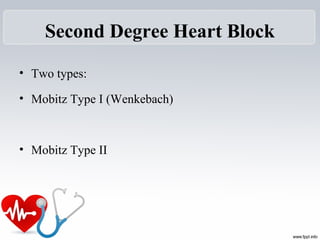 Second Degree Heart Block
• Two types:
• Mobitz Type I (Wenkebach)
• Mobitz Type II
 