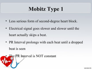 Mobitz Type 1
• Less serious form of second-degree heart block.
• Electrical signal goes slower and slower until the 
heart actually skips a beat.
• PR Interval prolongs with each beat until a dropped 
beat is seen
• The PR Interval is NOT constant
 