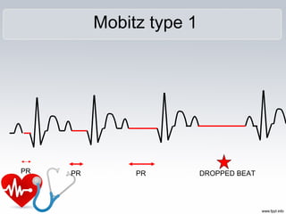 Mobitz type 1
PR PR PR DROPPED BEAT
 