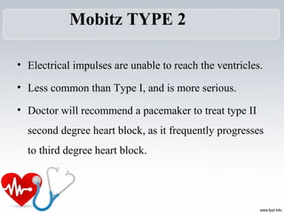 Mobitz TYPE 2
• Electrical impulses are unable to reach the ventricles. 
• Less common than Type I, and is more serious. 
• Doctor will recommend a pacemaker to treat type II 
second degree heart block, as it frequently progresses 
to third degree heart block. 
 
