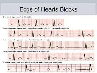 Ecgs of Hearts Blocks
 