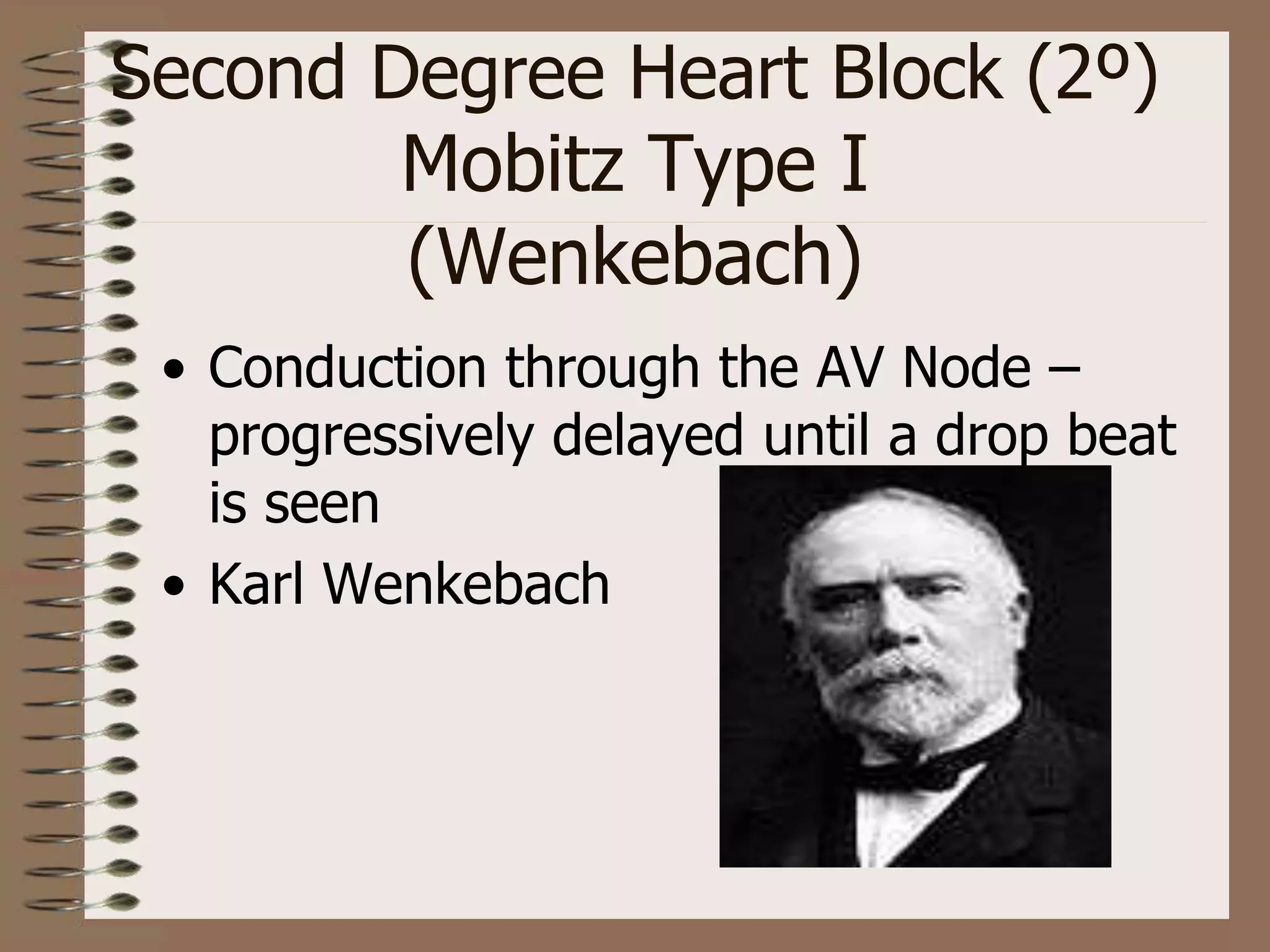 Second Degree Heart Block (2º)
Mobitz Type I
(Wenkebach)
• Conduction through the AV Node –
progressively delayed until a drop beat
is seen
• Karl Wenkebach
 