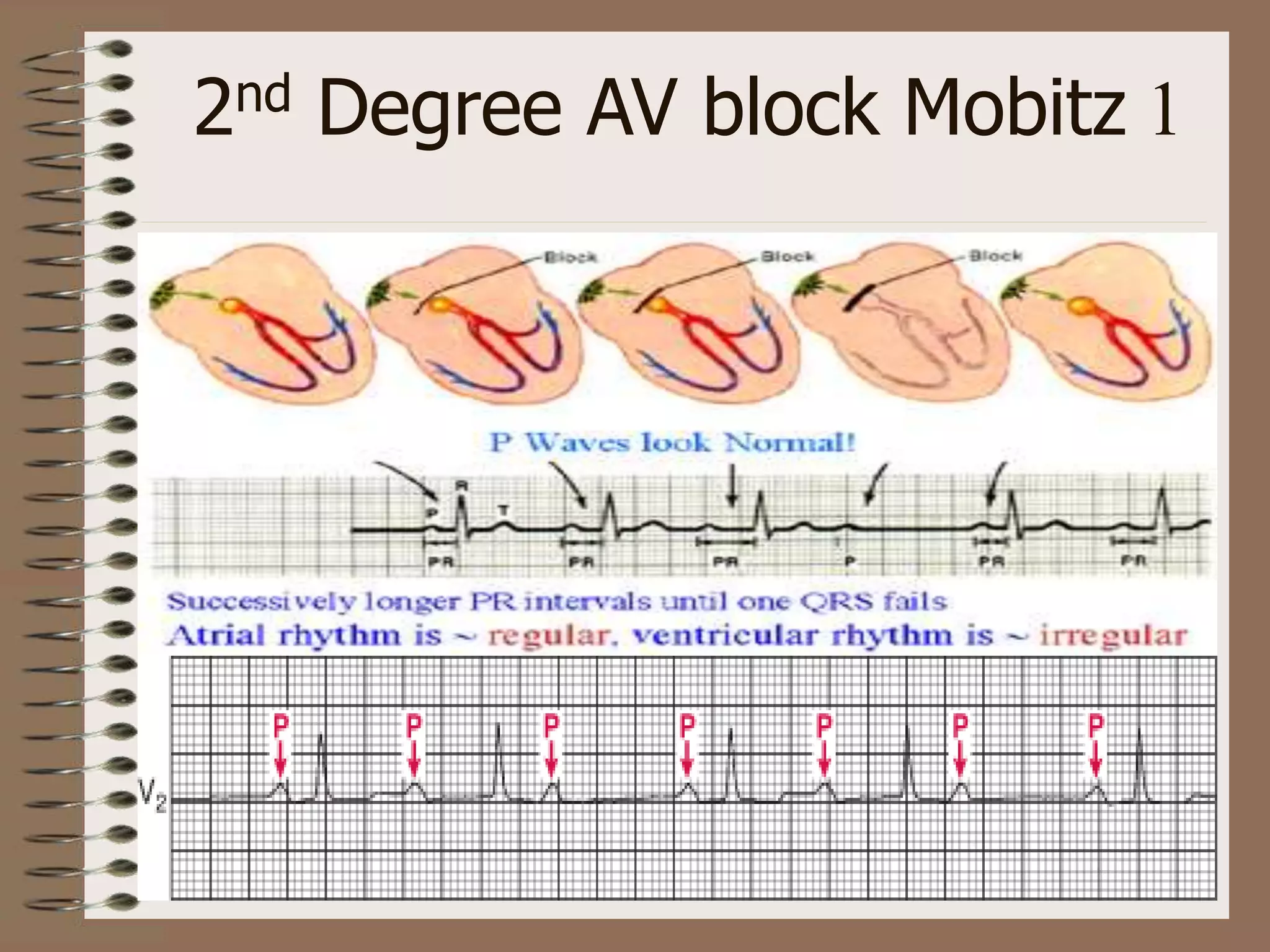 2nd Degree AV block Mobitz 1
 