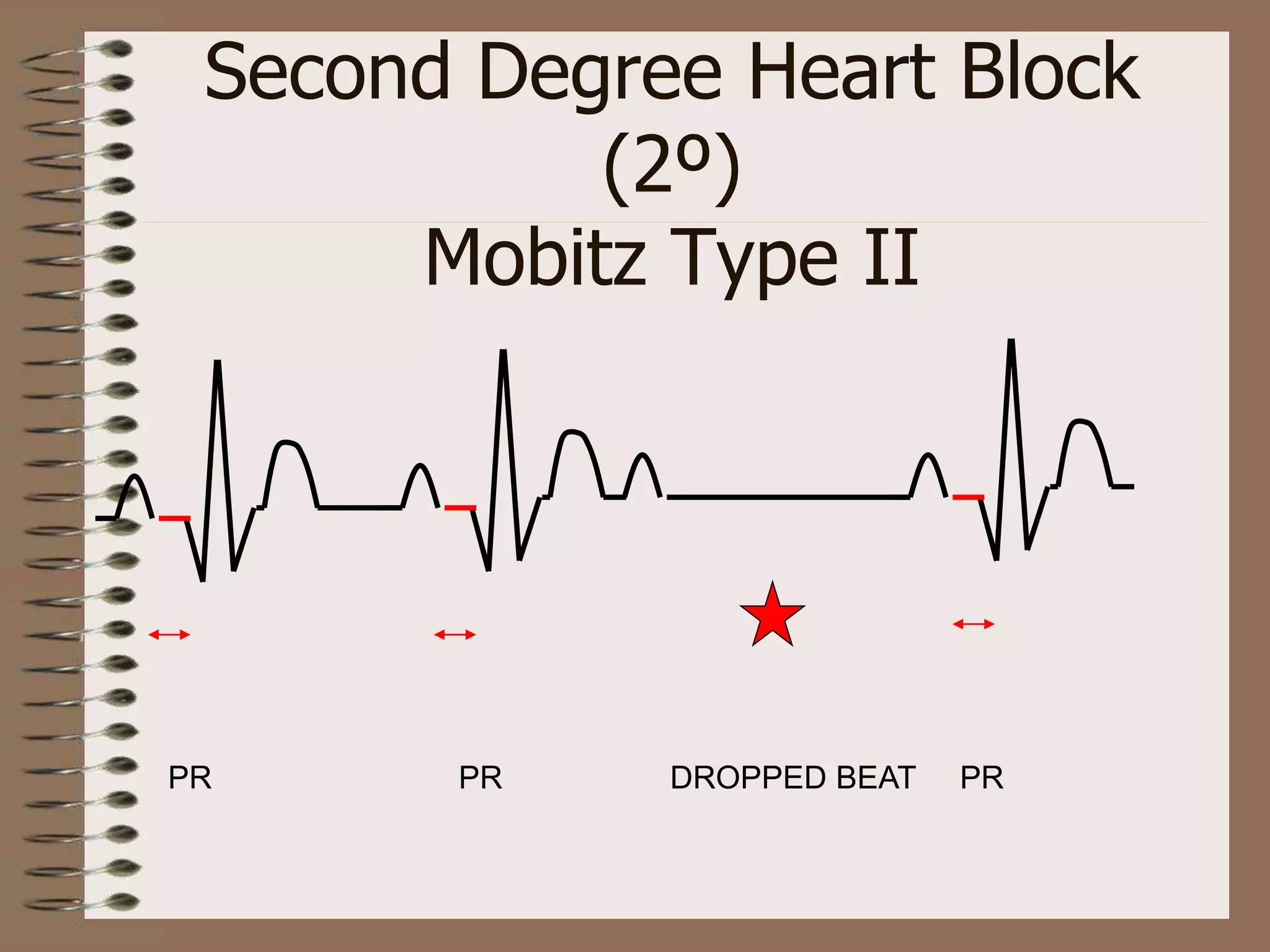 Second Degree Heart Block
(2º)
Mobitz Type II
PR PR DROPPED BEAT PR
 