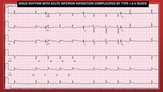 SINUS RHYTHM WITH ACUTE INFERIOR INFARCTION COMPLICATED BY TYPE I A-V BLOCK
 