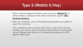 Type 2 (Mobitz II/Hay)
▪ Type 2 Second-degree AV block, also known as "Mobitz II," is
almost always a disease of the distal conduction system (His-
Purkinje System).
▪ With this condition, some of the electrical impulses are unable to
reach the ventricles.
▪ This condition is less common than Type I, and is more serious.
Usually, your doctor will recommend a pacemaker to treat type II
second degree heart block, as it frequently progresses to third
degree heart block
 
