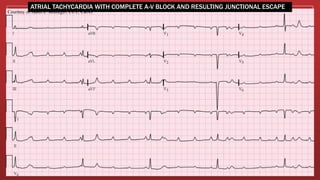ATRIAL TACHYCARDIA WITH COMPLETE A-V BLOCK AND RESULTING JUNCTIONAL ESCAPE
 