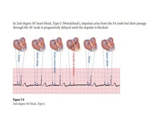 HEART BLOCKS IN ECG AND HOW TO INTEPRET IN ECG? | PPTX