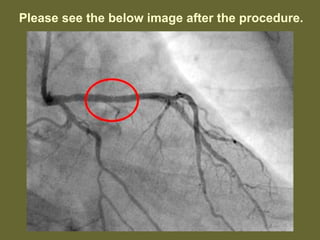 Please see the below image after the procedure.
 