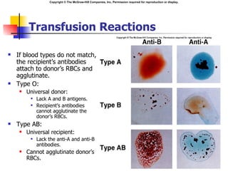 Copyright © The McGraw-Hill Companies, Inc. Permission required for reproduction or display.




        Transfusion Reactions

    If blood types do not match,
                                                                                 Insert fig. 13.6

                                                                           
    the recipient’s antibodies
    attach to donor’s RBCs and
    agglutinate.
   Type O:
       Universal donor:
            Lack A and B antigens.
            Recipient’s antibodies
             cannot agglutinate the
             donor’s RBCs.
   Type AB:
       Universal recipient:
            Lack the anti-A and anti-B
             antibodies.
       Cannot agglutinate donor’s
        RBCs.
 