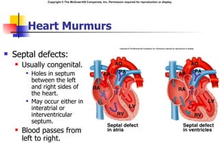 Copyright © The McGraw-Hill Companies, Inc. Permission required for reproduction or display.




         Heart Murmurs

   Septal defects:
       Usually congenital.
            Holes in septum
             between the left
             and right sides of
             the heart.
            May occur either in
             interatrial or
             interventricular
             septum.
       Blood passes from
        left to right.
 