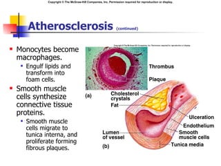 Copyright © The McGraw-Hill Companies, Inc. Permission required for reproduction or display.




         Atherosclerosis                                           (continued)




   Monocytes become
    macrophages.
        Engulf lipids and
         transform into
         foam cells.
   Smooth muscle
    cells synthesize
    connective tissue
    proteins.
        Smooth muscle
         cells migrate to
         tunica interna, and
         proliferate forming
         fibrous plaques.
 