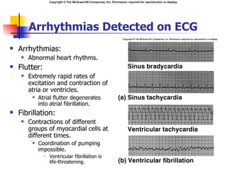 Copyright © The McGraw-Hill Companies, Inc. Permission required for reproduction or display.




        Arrhythmias Detected on ECG
   Arrhythmias:
       Abnormal heart rhythms.
   Flutter:
       Extremely rapid rates of
        excitation and contraction of
        atria or ventricles.
            Atrial flutter degenerates
             into atrial fibrillation.
   Fibrillation:
       Contractions of different
        groups of myocardial cells at
        different times.
            Coordination of pumping
             impossible.
                  Ventricular fibrillation is
                   life-threatening.
 