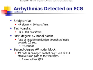 Copyright © The McGraw-Hill Companies, Inc. Permission required for reproduction or display.




    Arrhythmias Detected on ECG
    (continued)




   Bradycardia:
        HR slower < 60 beats/min.
   Tachycardia:
        HR > 100 beats/min.
   First–degree AV nodal block:
        Rate of impulse conduction through AV node
         exceeds 0.2 sec.
             P-R interval.
   Second-degree AV nodal block:
        AV node is damaged so that only 1 out of 2-4
         atrial APs can pass to the ventricles.
             P wave without QRS.
 