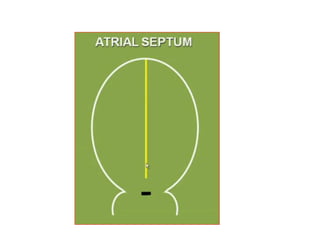 Rt Lt
Septum primum- flexible
Septum secundum- rigid
Septum secundum:
Crescent shaped fold just
right of septum primum.
 