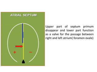 Atrial Septal Defect
Primum type ASD: Acyanotic
 