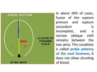 Ventricular Septation
Ventricle in figure = primitive ventricle+ proximal part of BC
+ conus cordis.
 