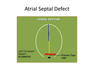Conus
Muscular IV septum
IV foramen
Conus septum
Membranous IV septum
 