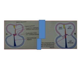 Persistent Truncus Arteriosus:
No division of TA
VSD
Cyanotic disorder
 